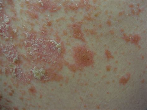Pityriasis rubra pilaris