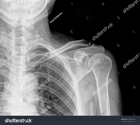 What Does A Normal Left Shoulder X Ray Look Like at Ann Sexton blog