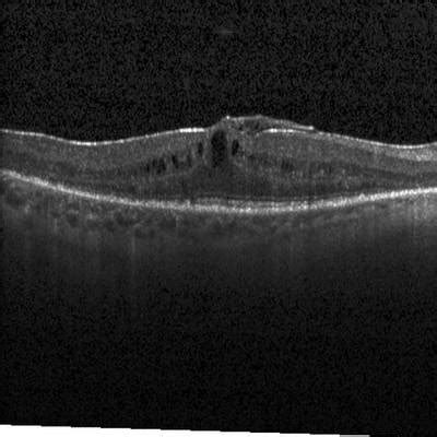 Intraretinal Cystoid Fluid - Dataset Ninja