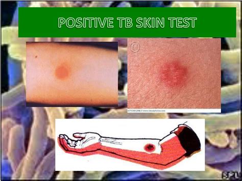 Labcorp Tb Test Near Me at Lachlan Ricardo blog