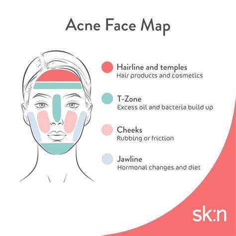 Use our acne face map to find out what type of breakout you've got | sk:n clinics