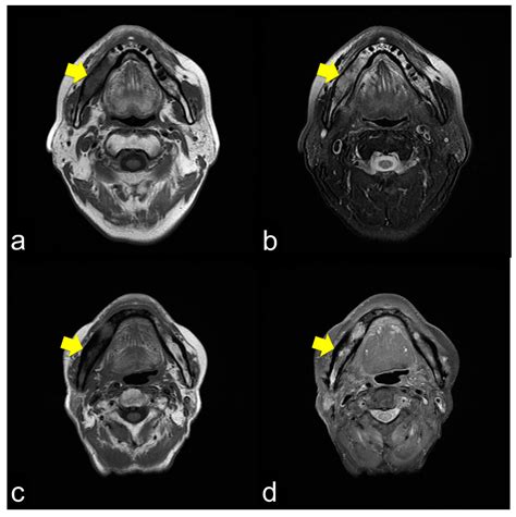 Clinical Diagnostic Imaging Study of Osteoradionecrosis of the Jaw: A Retrospective Study