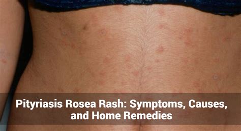 Image result for Rash Algorithm Pityriasis