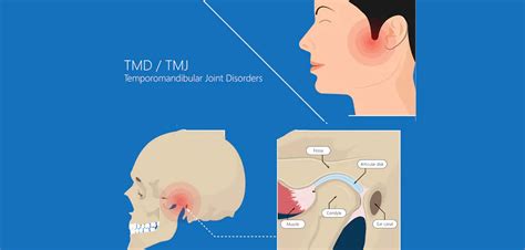 Temporomandibular Joint Disorder Near Gaithersburg MD | TMJ