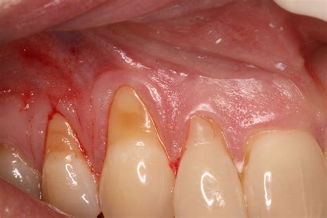 Soft Tissue / Gum Recession Treatment Archives - Ryan Lanman DDS, MSD