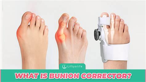 What Does A Bunion Guard Do at Ava Lazarev blog