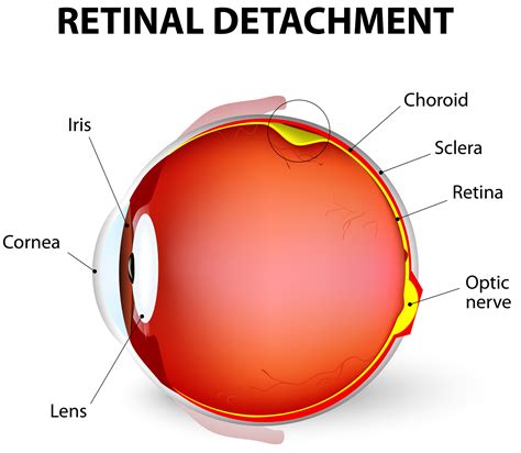 Retinal Detachment - Causes, Signs, Symptoms, Surgery, Repair