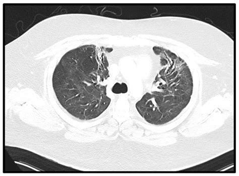 Sustained Treatment Response after Intravenous Cyclophosphamide in a ...
