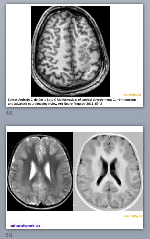 Image result for Neocortex Disorders