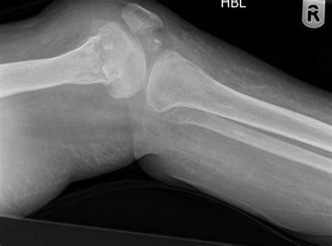 Isolated lower limb hypoplasia secondary to congenital varicella ...