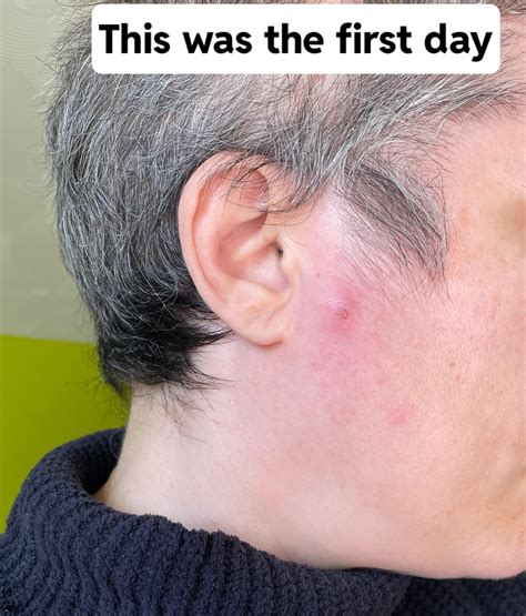 Image result for Painful Giant Abscess Exploding