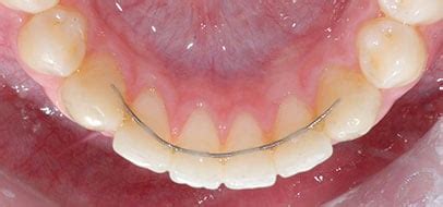 Image result for Retainer Problems