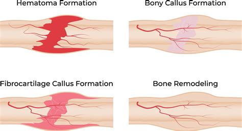 Stages of Bone Fracture Healing Hematoma Callus Formation and ...