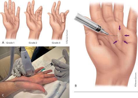 Injections of the Hand and Wrist: Part I. Trigger Finger, First Carpometacarpal Joint ...