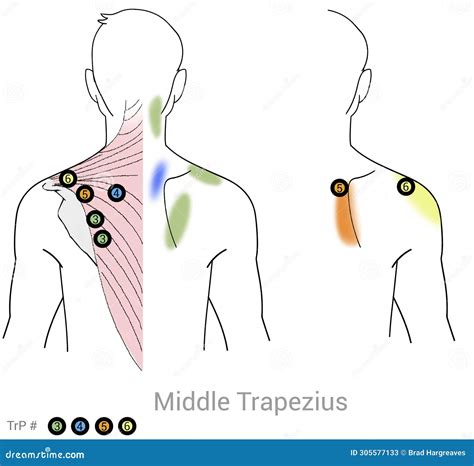 Upper Trapezius: Managing Pain Arriving from Myofascial Trigger Points ...