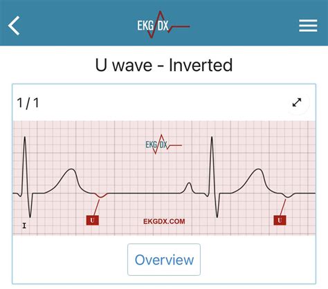 1/ Let’s talk about U waves #CardioTwitter. The U wave is a deflection ...