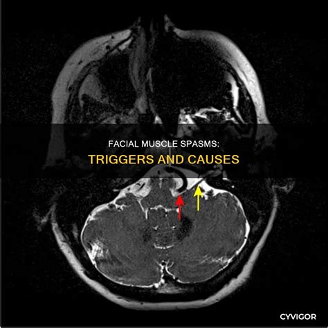 Facial Muscle Spasms: Triggers And Causes | CyVigor