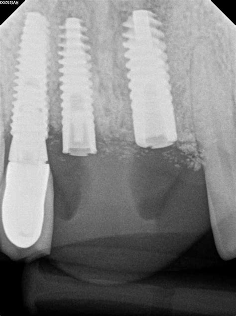 Ankylos 3.5x14 (#8) and 4.5 x 14 (#9): loosening and broken screws ...