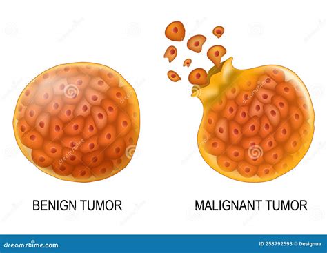 Cancer Cells in Benign Neoplasm and Malignant Tumors Stock Vector ...