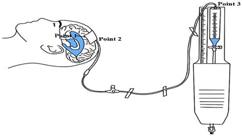Analysis of Drainage Volume in External Ventricular Drainage Based on Intracranial Pressure and ...