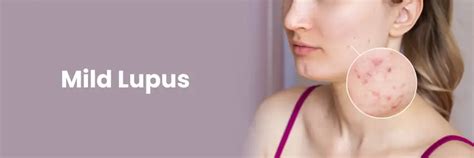 Mild Lupus: Symptoms and Management