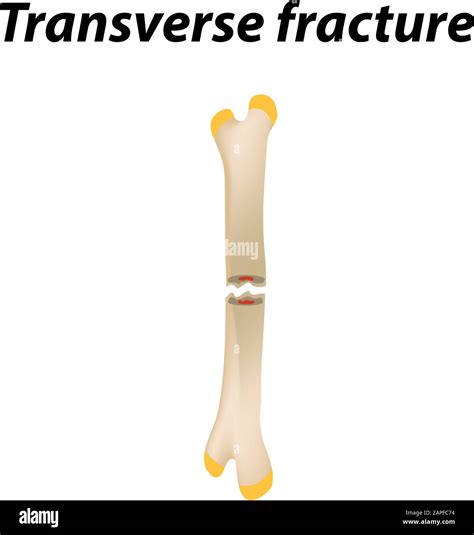 Transverse Fractures