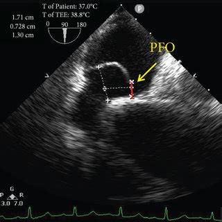 PFO Defect 的图像结果