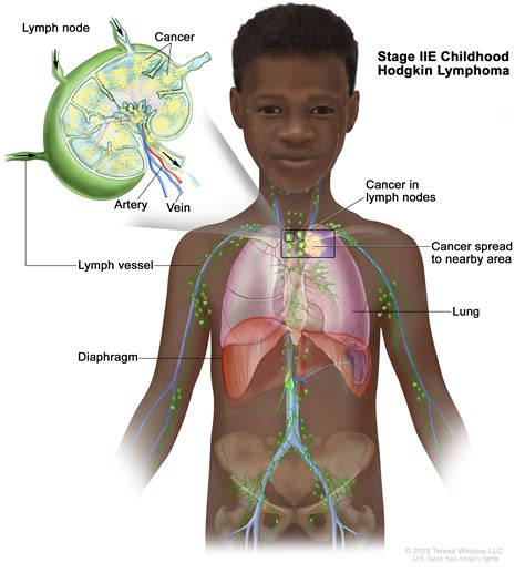Childhood Hodgkin Lymphoma Treatment (PDQ®)–Patient Version - Siteman Cancer Center