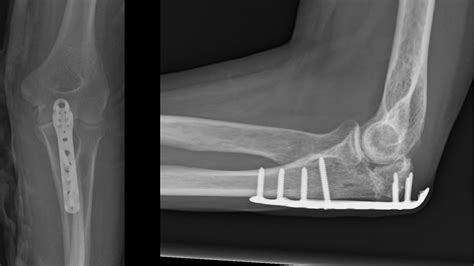 Elbow Fracture: Recovery Timeline: What to Expect & How to Heal Faster