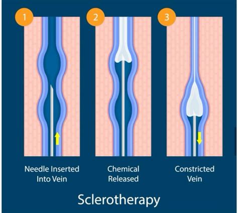What Is Sclerotherapy