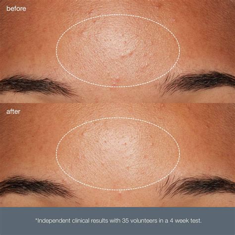 Clogged Pores Forehead