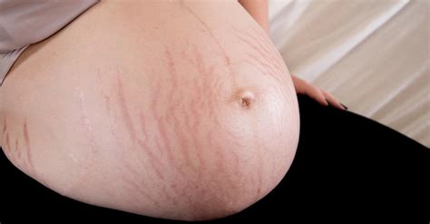 Buy Best Stretch Marks Cream Online in India – AreoVeda