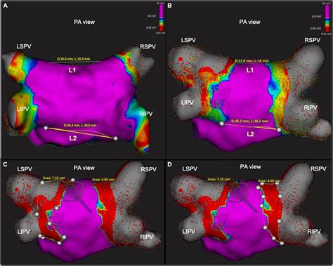Bilateral Pulmonary Vein Isolation