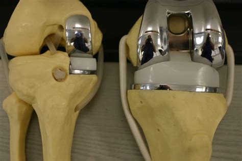 How many knee replacements per year? - STOVER PT - what happens when knee replacement wears out
