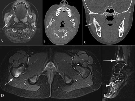 Frontiers | Chronic recurrent multifocal osteomyelitis. A narrative and pictorial review