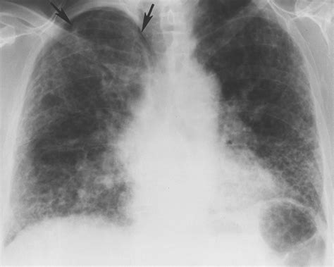 Hypersensitivity Pneumonitis | AJR