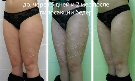 Липосакция бёдер, толстых ног у женщин. Фото до и после, цена, отзывы