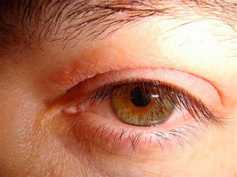 Eyelid Rash - Pictures, Causes, Symptoms and Treatment