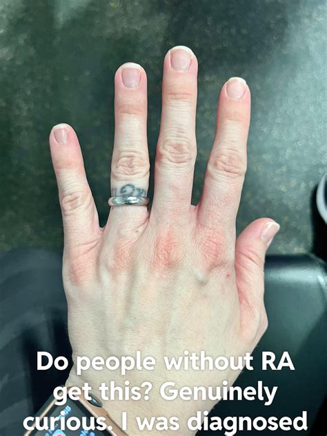Red knuckles : r/rheumatoid