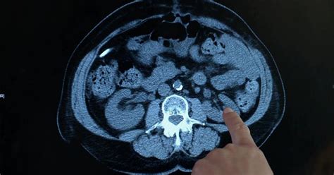 Image result for Removing Fallopian Tubes