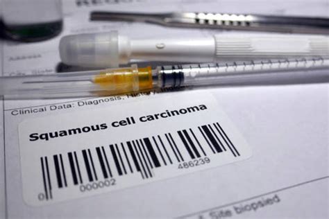 Diagnosis and Treatment Options for Squamous Cell Carcinoma – Caresupp.in