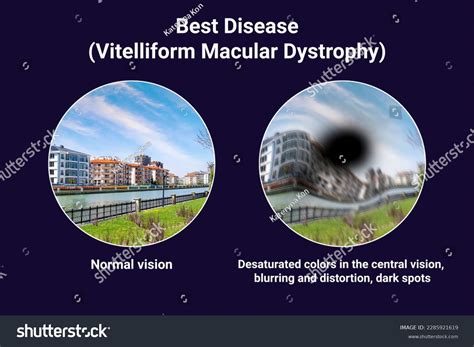Black Spots In Vision
