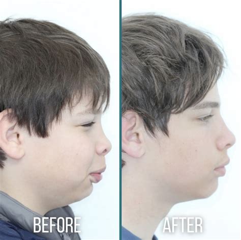 Overbite Before And After Pictures