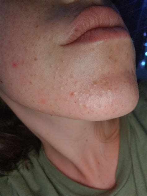 [acne] Under the skin bumps all around the chin area. I am currently on ...