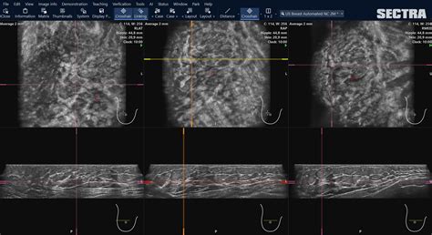 Case study: One for all — native support for automated breast ultrasound (ABUS) in Sectra’s ...