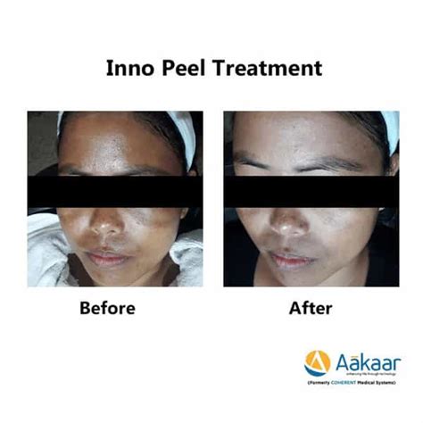 Buy INNO EXFO LIGHTENING CREAM Online & Get Upto 60% OFF at PharmEasy
