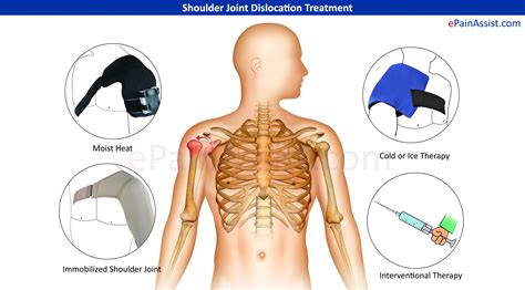 Shoulder Joint Dislocation: Treatment, Symptoms, Signs