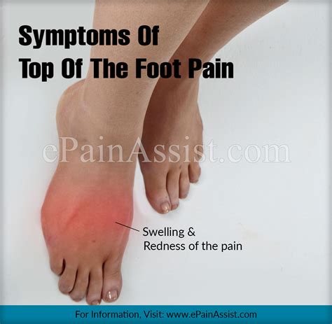 Foot Pain Diagram - exatin.info