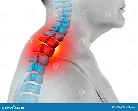 Neck Pain, Sciatica and Scoliosis in the Cervical Spine Isolated on White Background ...