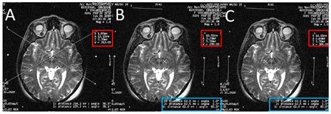 Using “Functional” Target Coordinates of the Subthalamic Nucleus to ...